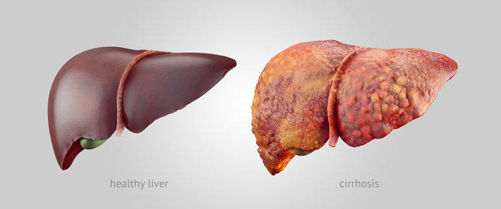 liver with cirrhosis 