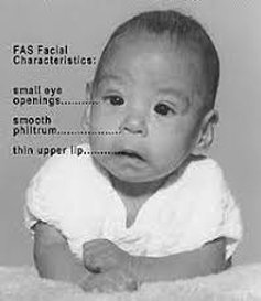 Baby with symptoms of fetal alcohol spectrum disorder. 