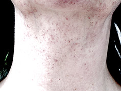 Purpura reaction on the necks skin
