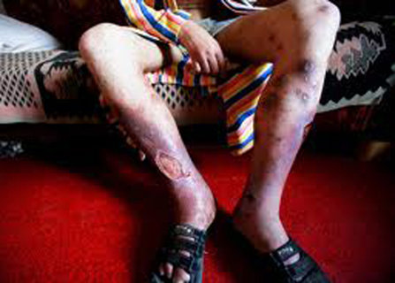 body with damage from krokodil