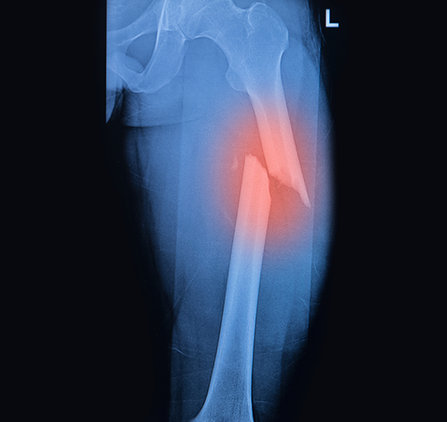 Broken femur x-ray/
